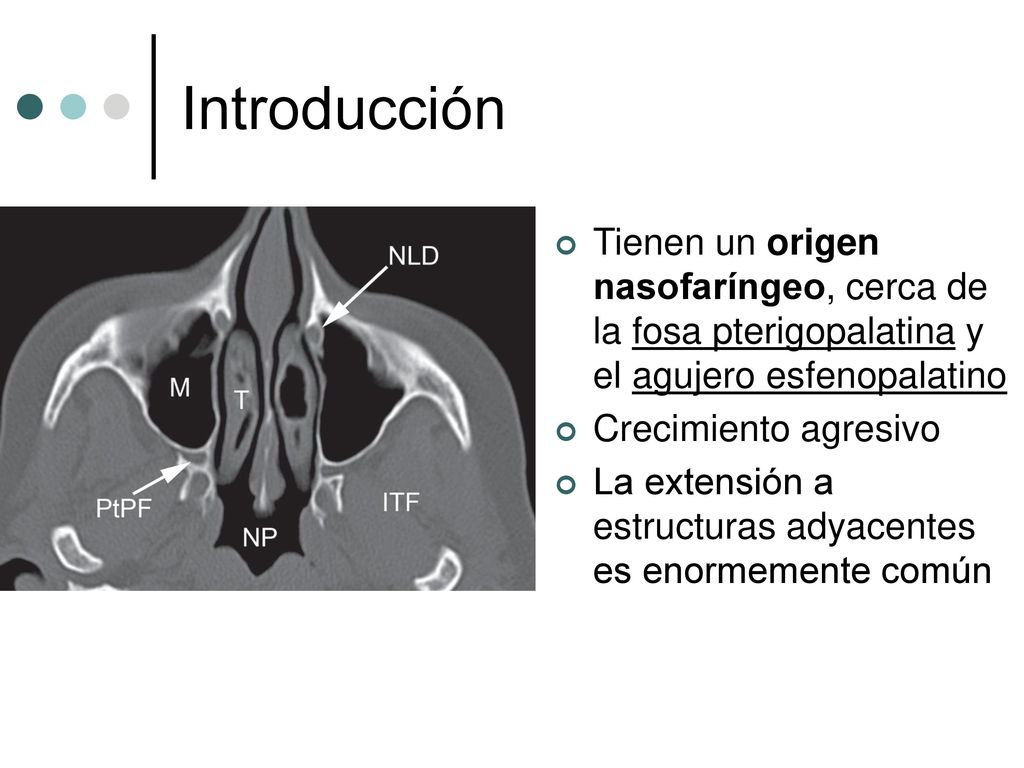 Introducción Tienen un origen nasofaríngeo, cerca de la fosa pterigopalatina y el agujero esfenopalatino.