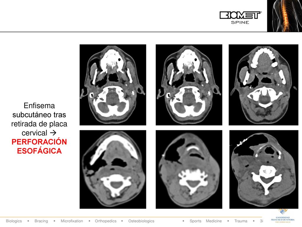 Enfisema subcutáneo tras retirada de placa cervical  PERFORACIÓN ESOFÁGICA