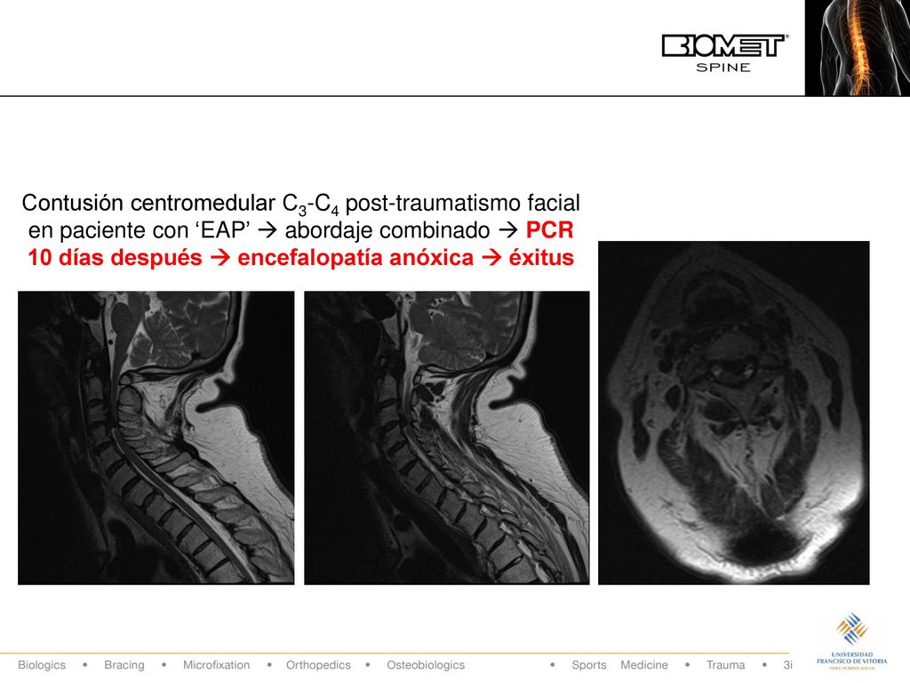 Contusión centromedular C3-C4 post-traumatismo facial en paciente con ‘EAP’  abordaje combinado  PCR 10 días después  encefalopatía anóxica  éxitus