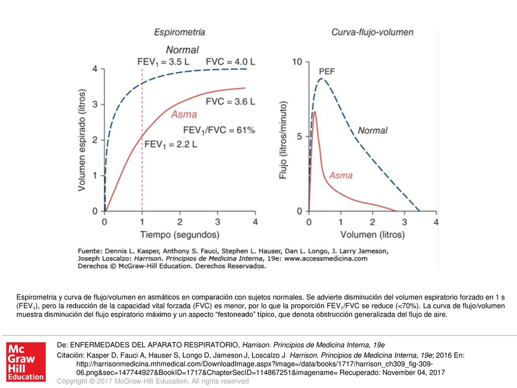 Espirometria y curva de flujo/volumen en asmáticos en comparación con sujetos normales. Se advierte disminución del volumen espiratorio forzado en 1 s (FEV1), pero la reducción de la capacidad vital forzada (FVC) es menor, por lo que la proporción FEV1/FVC se reduce (<70%). La curva de flujo/volumen muestra disminución del flujo espiratorio máximo y un aspecto festoneado típico, que denota obstrucción generalizada del flujo de aire.