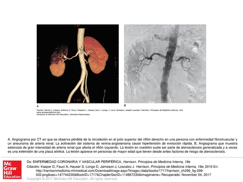 A. Angiograma por CT en que se observa pérdida de la circulación en el polo superior del riñón derecho en una persona con enfermedad fibromuscular y un aneurisma de arteria renal. La activación del sistema de renina-angiotensina causó hipertensión de evolución rápida. B. Angiograma que muestra estenosis de gran intensidad de arteria renal que afecta el riñón izquierdo. La lesión en cuestión suele ser parte de aterosclerosis generalizada y a veces es una extensión de una placa aórtica. La lesión aparece en personas de mayor edad que tienen desde antes factores de riesgo de aterosclerosis.