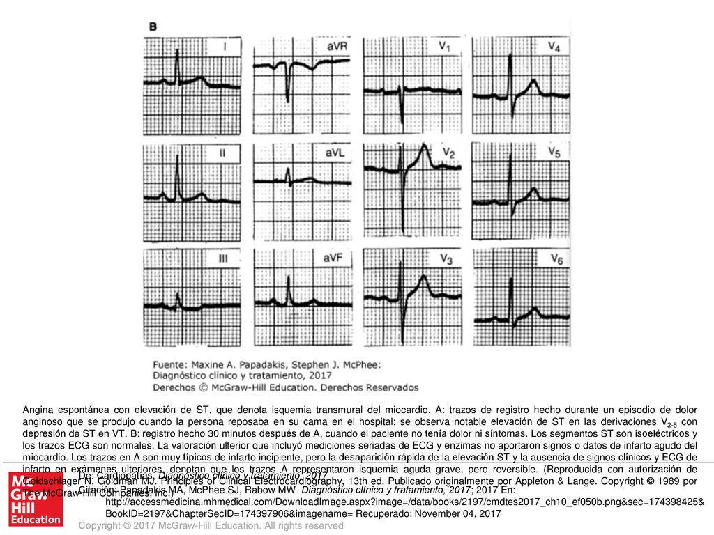 Angina espontánea con elevación de ST, que denota isquemia transmural del miocardio. A: trazos de registro hecho durante un episodio de dolor anginoso que se produjo cuando la persona reposaba en su cama en el hospital; se observa notable elevación de ST en las derivaciones V2-5 con depresión de ST en VT. B: registro hecho 30 minutos después de A, cuando el paciente no tenía dolor ni síntomas. Los segmentos ST son isoeléctricos y los trazos ECG son normales. La valoración ulterior que incluyó mediciones seriadas de ECG y enzimas no aportaron signos o datos de infarto agudo del miocardio. Los trazos en A son muy típicos de infarto incipiente, pero la desaparición rápida de la elevación ST y la ausencia de signos clínicos y ECG de infarto en exámenes ulteriores, denotan que los trazos A representaron isquemia aguda grave, pero reversible. (Reproducida con autorización de Goldschlager N, Goldman MJ. Principles of Clinical Electrocardiography, 13th ed. Publicado originalmente por Appleton & Lange. Copyright © 1989 por The McGraw-Hill Companies, Inc.)