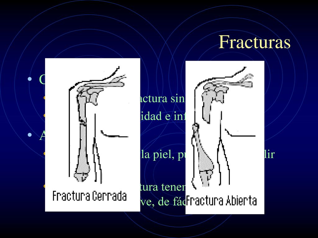 Fracturas Cerradas Abiertas la piel rodea la fractura sin fisuras