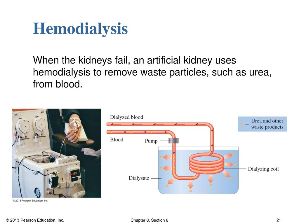 Hemodialysis When the kidneys fail, an artificial kidney uses hemodialysis to remove waste particles, such as urea, from blood.