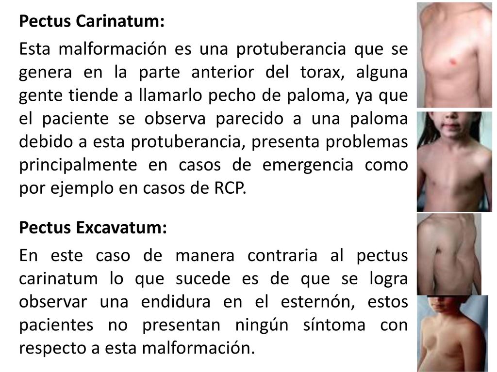 Pectus Carinatum: Esta malformación es una protuberancia que se genera en la parte anterior del torax, alguna gente tiende a llamarlo pecho de paloma, ya que el paciente se observa parecido a una paloma debido a esta protuberancia, presenta problemas principalmente en casos de emergencia como por ejemplo en casos de RCP.