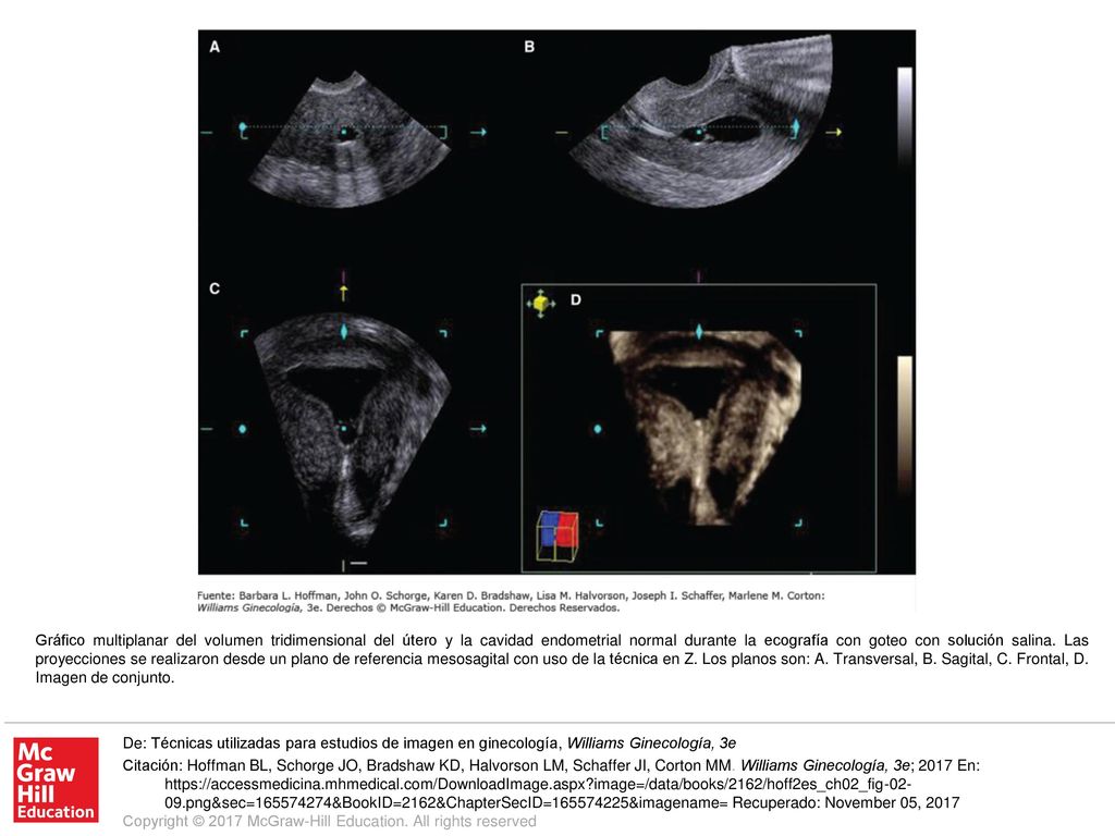 Gráfico multiplanar del volumen tridimensional del útero y la cavidad endometrial normal durante la ecografía con goteo con solución salina. Las proyecciones se realizaron desde un plano de referencia mesosagital con uso de la técnica en Z. Los planos son: A. Transversal, B. Sagital, C. Frontal, D. Imagen de conjunto.