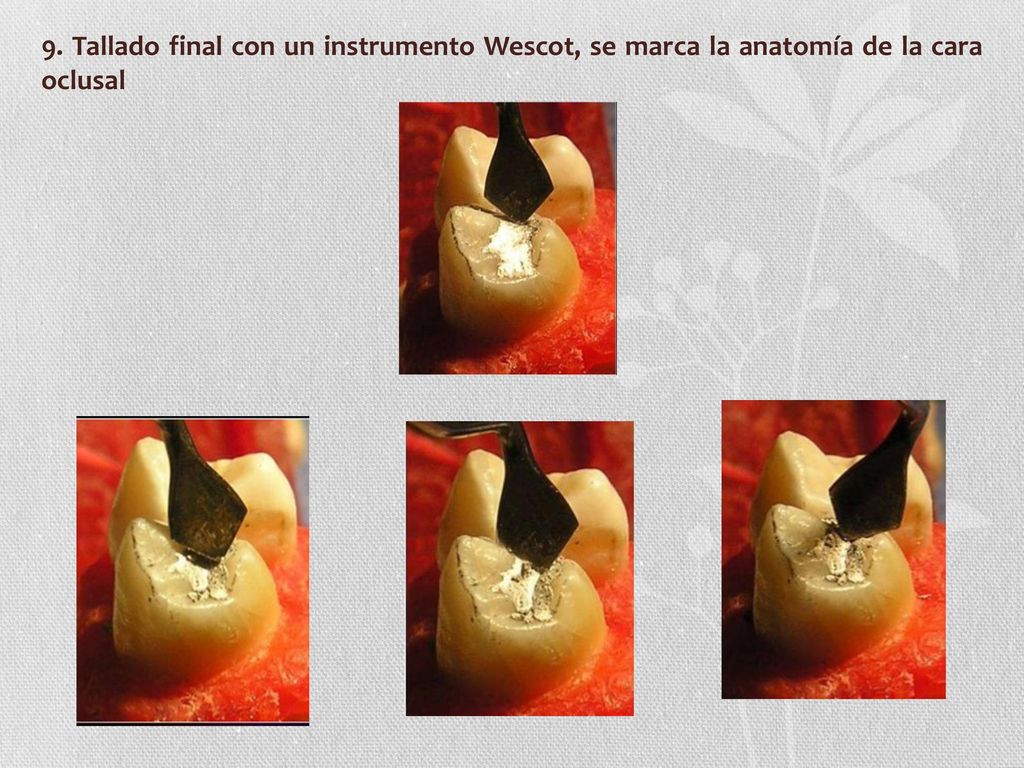 9. Tallado final con un instrumento Wescot, se marca la anatomía de la cara oclusal