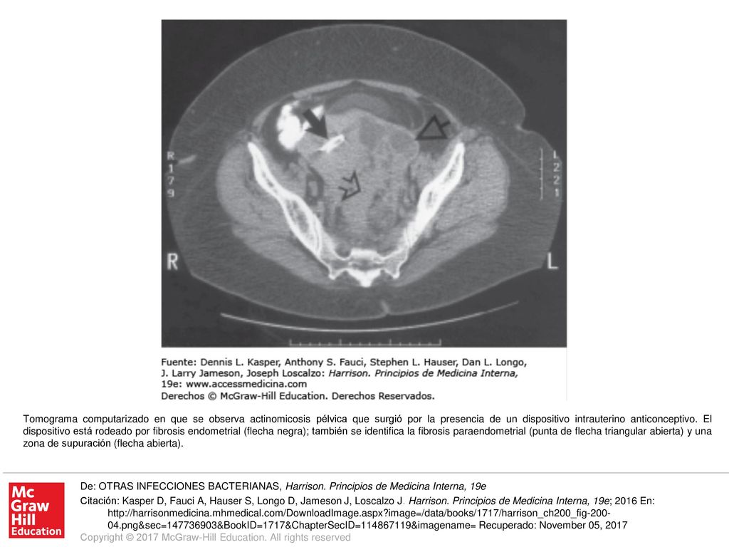 Tomograma computarizado en que se observa actinomicosis pélvica que surgió por la presencia de un dispositivo intrauterino anticonceptivo. El dispositivo está rodeado por fibrosis endometrial (flecha negra); también se identifica la fibrosis paraendometrial (punta de flecha triangular abierta) y una zona de supuración (flecha abierta).