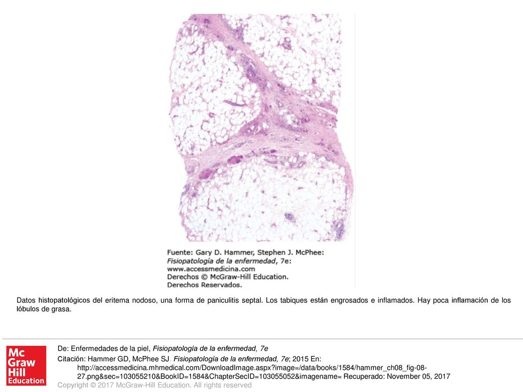 Datos histopatológicos del eritema nodoso, una forma de paniculitis septal. Los tabiques están engrosados e inflamados. Hay poca inflamación de los lóbulos de grasa.