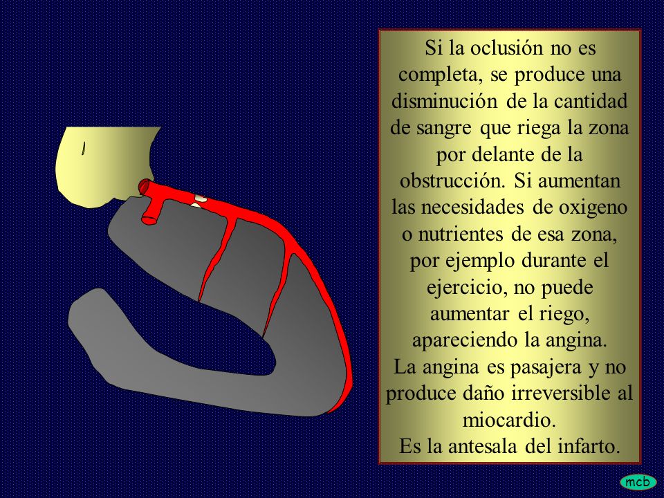 La angina es pasajera y no produce daño irreversible al miocardio.