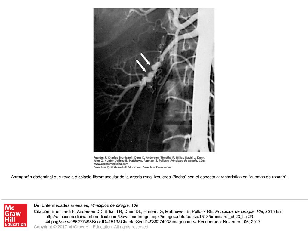 Aortografía abdominal que revela displasia fibromuscular de la arteria renal izquierda (flecha) con el aspecto característico en cuentas de rosario .