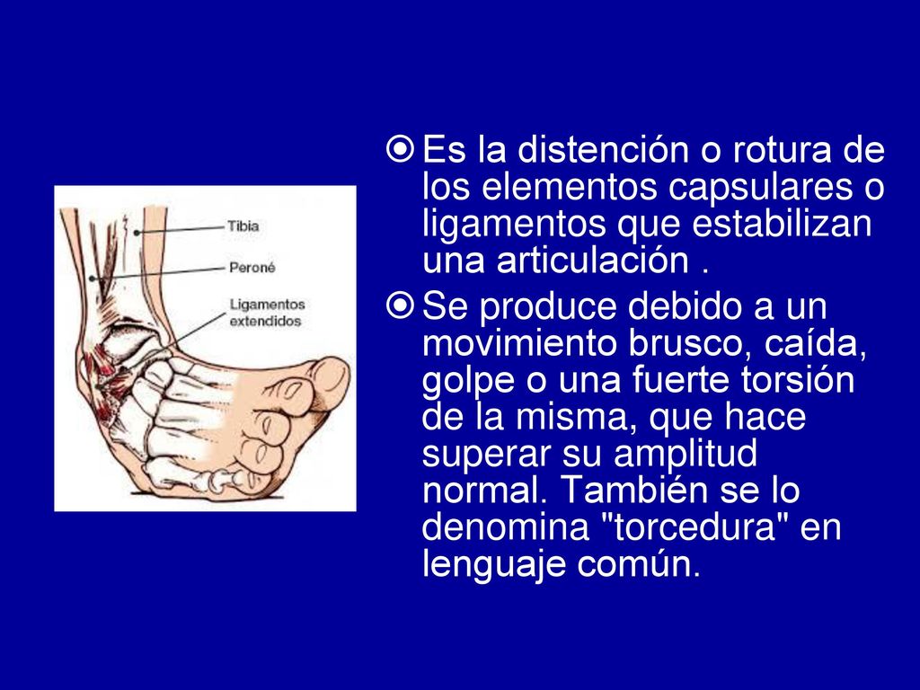 Es la distención o rotura de los elementos capsulares o ligamentos que estabilizan una articulación .