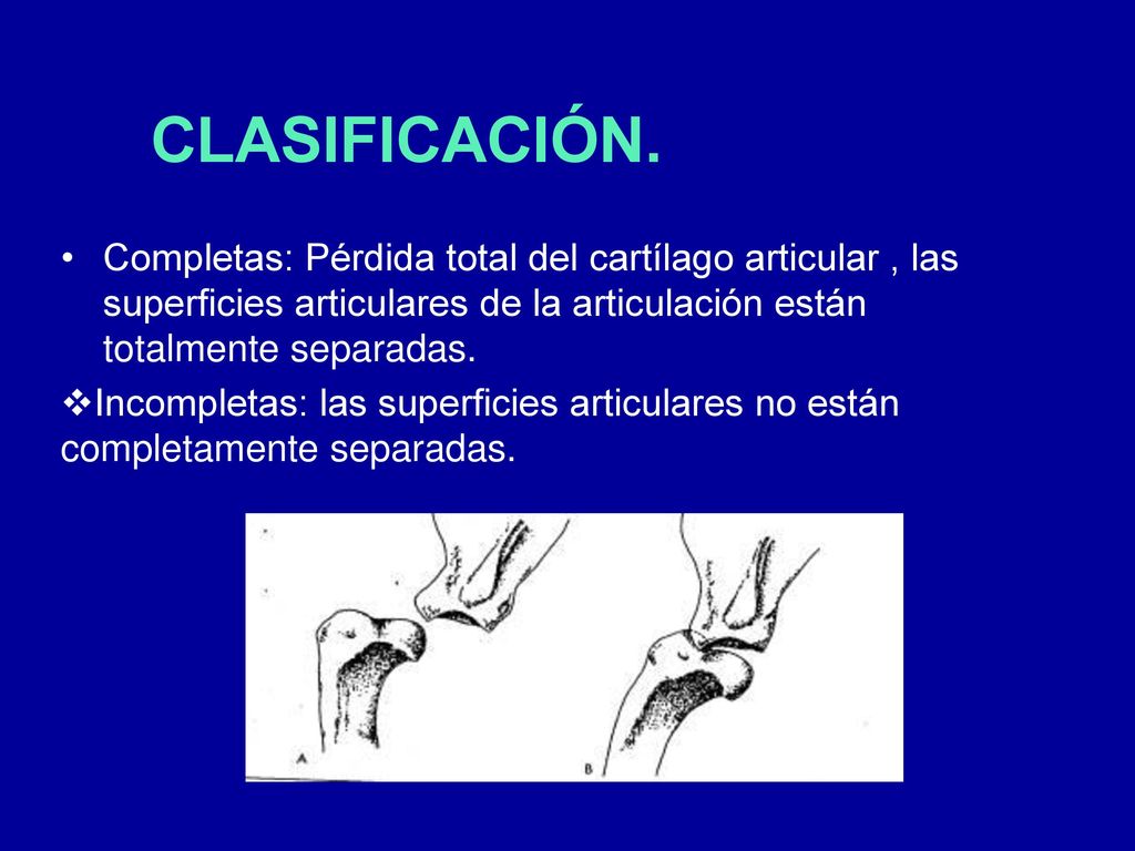 Completas: Pérdida total del cartílago articular , las superficies articulares de la articulación están totalmente separadas.