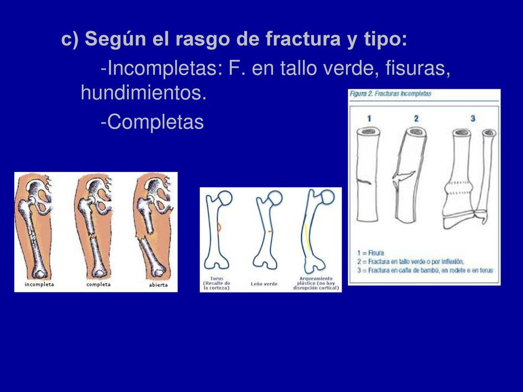 c) Según el rasgo de fractura y tipo: