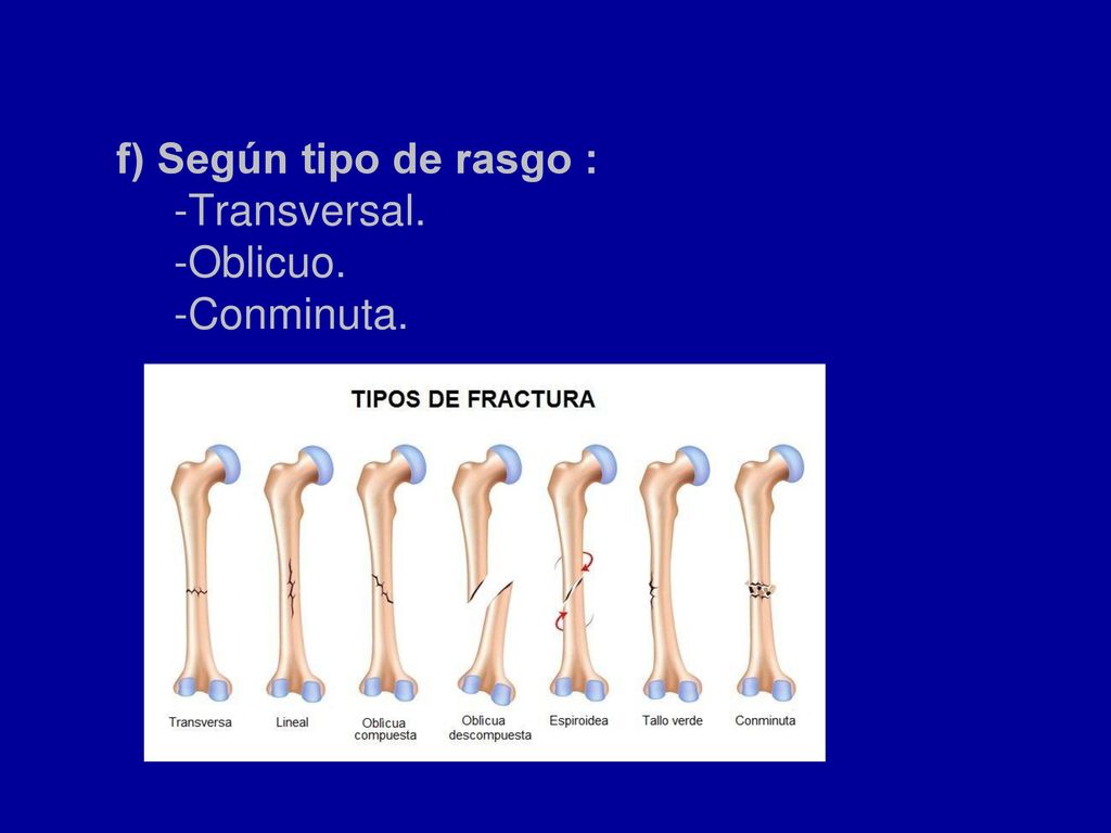 f) Según tipo de rasgo : -Transversal. -Oblicuo. -Conminuta.