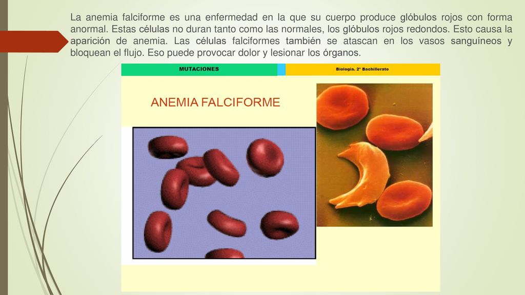 La anemia falciforme es una enfermedad en la que su cuerpo produce glóbulos rojos con forma anormal.