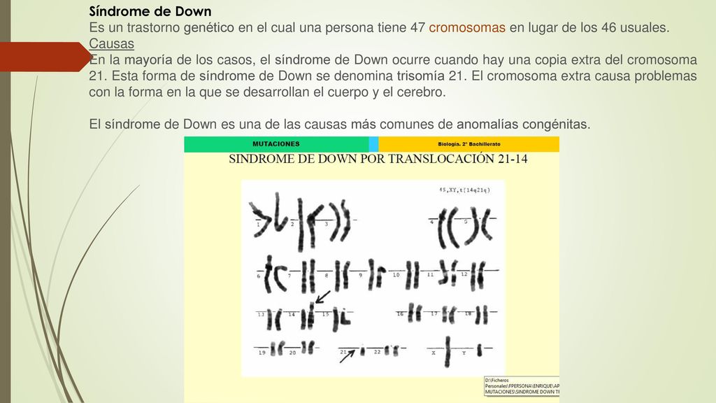 Síndrome de Down Es un trastorno genético en el cual una persona tiene 47 cromosomas en lugar de los 46 usuales.