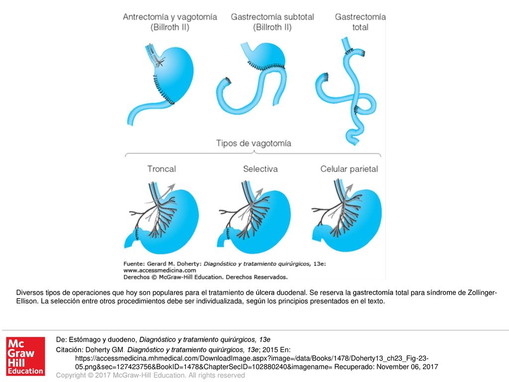 Diversos tipos de operaciones que hoy son populares para el tratamiento de úlcera duodenal. Se reserva la gastrectomía total para síndrome de Zollinger-Ellison. La selección entre otros procedimientos debe ser individualizada, según los principios presentados en el texto.