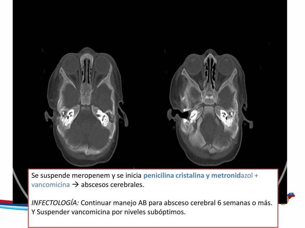 Ocupación por material de tejidos blandos del oído medio y las celdillas mastoideas por otomastoiditis bilateral de aspecto crónico por esclerosis de las mastoides