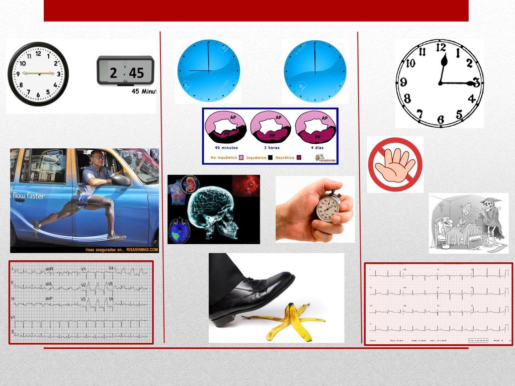 DEBEMOS CONSIDERAR ANTES DE LA INDICACION DE TBL LA SITUACION geográfica donde se encuentre el paciente en el momento del primer contacto médico; b) el tiempo de evolución del infarto, c) la disponibilidad inmediata de recursos de APTC Y LAS CARÁCTER{ISTICAS CLINICAS
