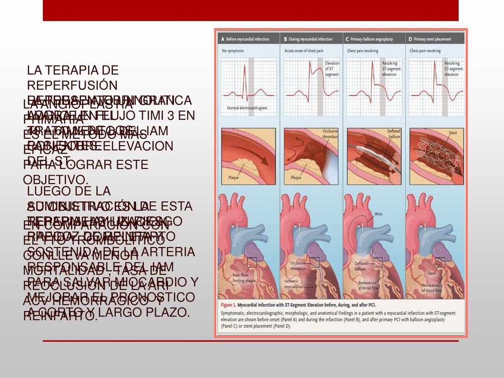 LA TERAPIA DE REPERFUSIÓN REPRESENTO UN GRAN AVANCE EN EL TRATAMIENTO DEL IAM CON SOBREELEVACION DEL ST.