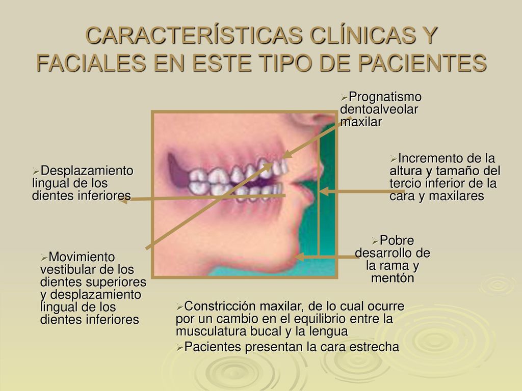 CARACTERÍSTICAS CLÍNICAS Y FACIALES EN ESTE TIPO DE PACIENTES