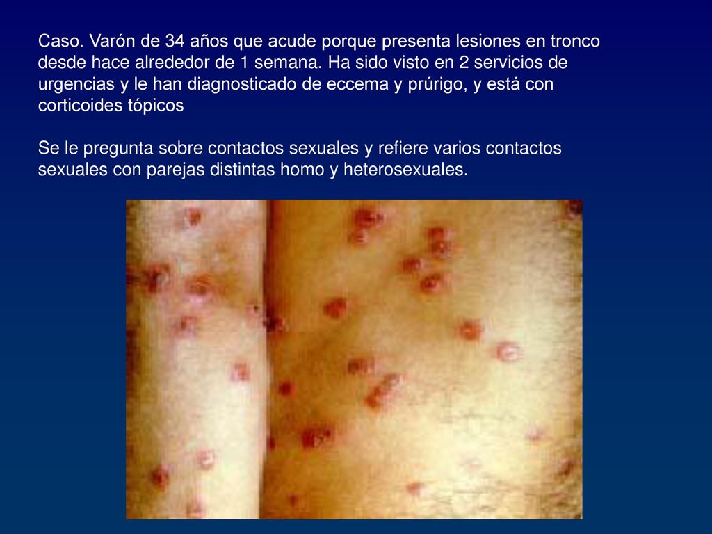 Caso. Varón de 34 años que acude porque presenta lesiones en tronco desde hace alrededor de 1 semana. Ha sido visto en 2 servicios de urgencias y le han diagnosticado de eccema y prúrigo, y está con corticoides tópicos