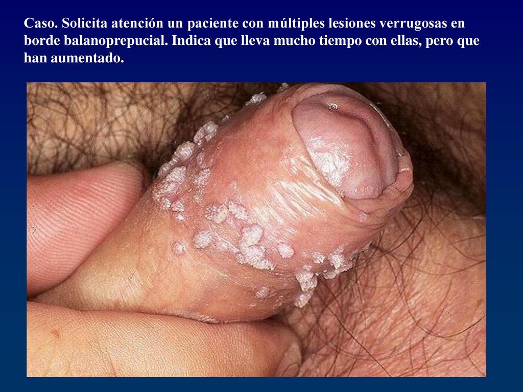 Caso. Solicita atención un paciente con múltiples lesiones verrugosas en borde balanoprepucial.