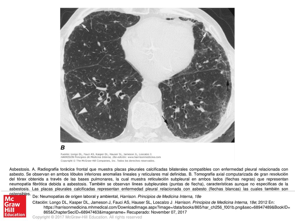 Asbestosis. A. Radiografía torácica frontal que muestra placas pleurales calcificadas bilaterales compatibles con enfermedad pleural relacionada con asbesto. Se observan en ambos lóbulos inferiores anomalías lineales y reticulares mal definidas. B. Tomografía axial computarizada de gran resolución del tórax obtenida a través de las bases pulmonares, la cual muestra reticulación subpleural en ambos lados (flechas negras) que representan neumopatía fibrótica debida a asbestosis. También se observan líneas subpleurales (puntas de flecha), características aunque no específicas de la asbestosis. Las placas pleurales calcificadas representan enfermedad pleural relacionada con asbesto (flechas blancas) las cuales también son ostensibles.