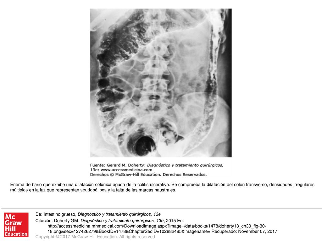 Enema de bario que exhibe una dilatación colónica aguda de la colitis ulcerativa. Se comprueba la dilatación del colon transverso, densidades irregulares múltiples en la luz que representan seudopólipos y la falta de las marcas haustrales.