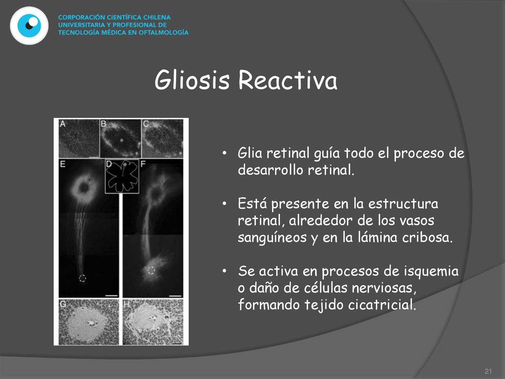 Gliosis Reactiva Glia retinal guía todo el proceso de desarrollo retinal.