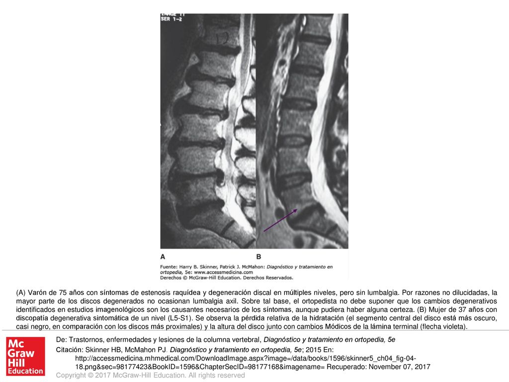 (A) Varón de 75 años con síntomas de estenosis raquídea y degeneración discal en múltiples niveles, pero sin lumbalgia. Por razones no dilucidadas, la mayor parte de los discos degenerados no ocasionan lumbalgia axil. Sobre tal base, el ortopedista no debe suponer que los cambios degenerativos identificados en estudios imagenológicos son los causantes necesarios de los síntomas, aunque pudiera haber alguna certeza. (B) Mujer de 37 años con discopatía degenerativa sintomática de un nivel (L5-S1). Se observa la pérdida relativa de la hidratación (el segmento central del disco está más oscuro, casi negro, en comparación con los discos más proximales) y la altura del disco junto con cambios Módicos de la lámina terminal (flecha violeta).