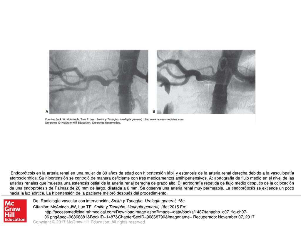 Endoprótesis en la arteria renal en una mujer de 80 años de edad con hipertensión lábil y estenosis de la arteria renal derecha debido a la vasculopatía aterosclerótica. Su hipertensión se controló de manera deficiente con tres medicamentos antihipertensivos. A: aortografía de flujo medio en el nivel de las arterias renales que muestra una estenosis ostial de la arteria renal derecha de grado alto. B: aortografía repetida de flujo medio después de la colocación de una endoprótesis de Palmaz de 20 mm de largo, dilatada a 6 mm. Se observa una arteria renal muy permeable. La endoprótesis se extiende un poco hacia la luz aórtica. La hipertensión de la paciente mejoró después del procedimiento.