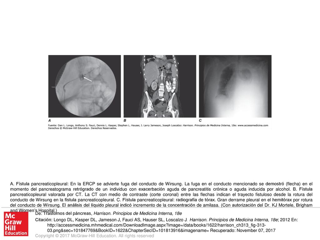 A. Fístula pancreaticopleural: En la ERCP se advierte fuga del conducto de Wirsung. La fuga en el conducto mencionado se demostró (flecha) en el momento del pancreatograma retrógrado de un individuo con exacerbación aguda de pancreatitis crónica o aguda inducida por alcohol. B. Fístula pancreaticopleural valorada por CT. La CT con medio de contraste (corte coronal) entre las flechas indican el trayecto fistuloso desde la rotura del conducto de Wirsung en la fístula pancreaticopleural. C. Fístula pancreaticopleural: radiografía de tórax. Gran derrame pleural en el hemitórax por rotura del conducto de Wirsung. El análisis del líquido pleural indicó incremento de la concentración de amilasa. (Con autorización del Dr. KJ Mortele, Brigham and Women’s Hospital.)