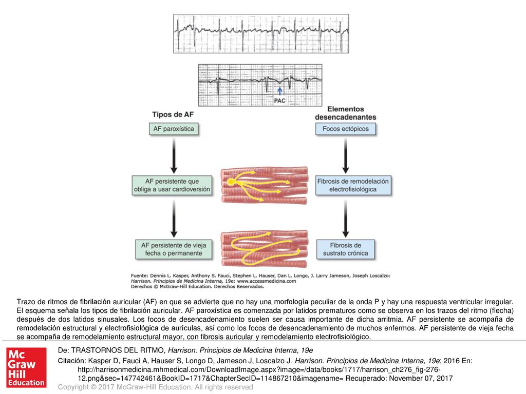 Trazo de ritmos de fibrilación auricular (AF) en que se advierte que no hay una morfología peculiar de la onda P y hay una respuesta ventricular irregular. El esquema señala los tipos de fibrilación auricular. AF paroxística es comenzada por latidos prematuros como se observa en los trazos del ritmo (flecha) después de dos latidos sinusales. Los focos de desencadenamiento suelen ser causa importante de dicha arritmia. AF persistente se acompaña de remodelación estructural y electrofisiológica de aurículas, así como los focos de desencadenamiento de muchos enfermos. AF persistente de vieja fecha se acompaña de remodelamiento estructural mayor, con fibrosis auricular y remodelamiento electrofisiológico.