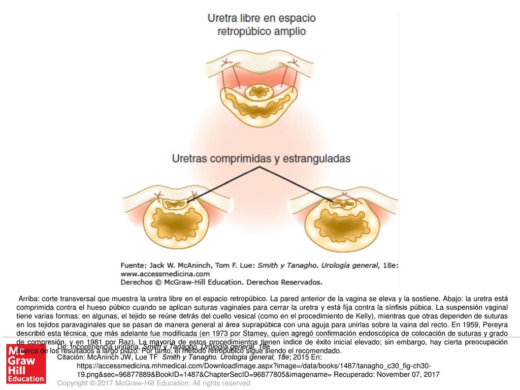 Arriba: corte transversal que muestra la uretra libre en el espacio retropúbico. La pared anterior de la vagina se eleva y la sostiene. Abajo: la uretra está comprimida contra el hueso púbico cuando se aplican suturas vaginales para cerrar la uretra y está fija contra la sínfisis púbica. La suspensión vaginal tiene varias formas: en algunas, el tejido se reúne detrás del cuello vesical (como en el procedimiento de Kelly), mientras que otras dependen de suturas en los tejidos paravaginales que se pasan de manera general al área suprapúbica con una aguja para unirlas sobre la vaina del recto. En 1959, Pereyra describió esta técnica, que más adelante fue modificada (en 1973 por Stamey, quien agregó confirmación endoscópica de colocación de suturas y grado de compresión, y en 1981 por Raz). La mayoría de estos procedimientos tienen índice de éxito inicial elevado; sin embargo, hay cierta preocupación acerca de los resultados a largo plazo. Por tanto, el método retropúbico sigue siendo el recomendado.