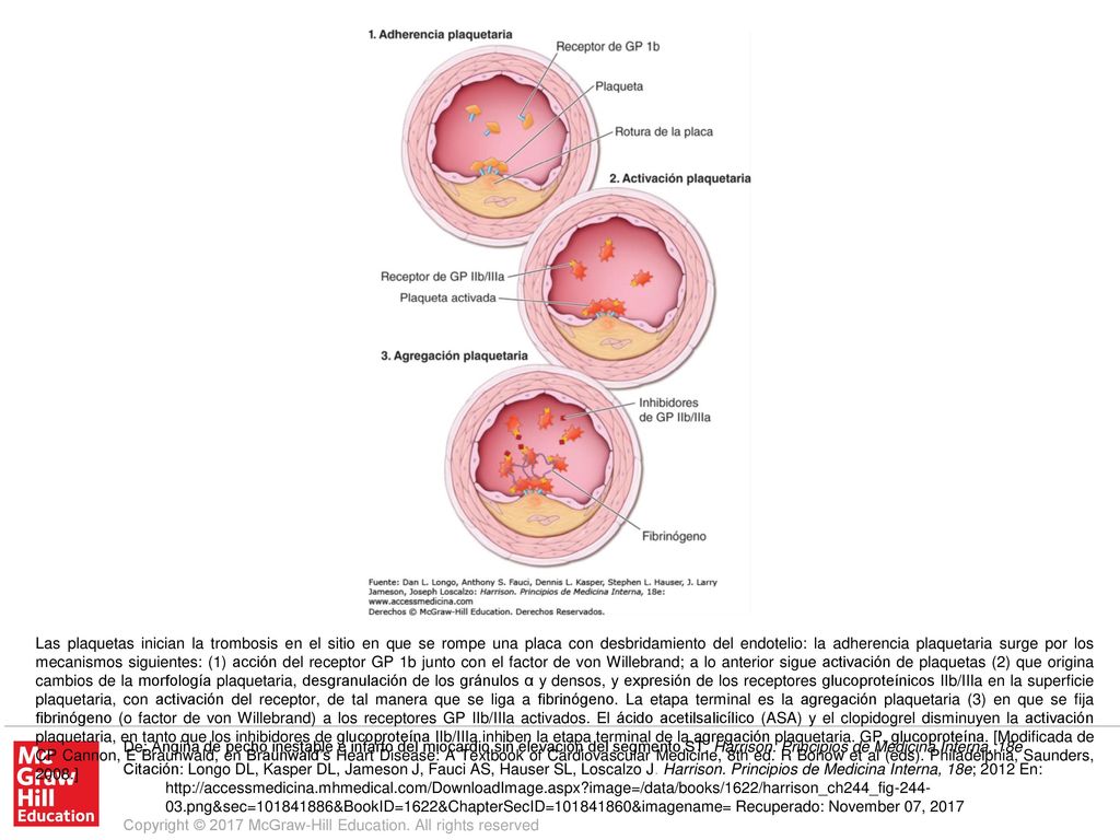 Las plaquetas inician la trombosis en el sitio en que se rompe una placa con desbridamiento del endotelio: la adherencia plaquetaria surge por los mecanismos siguientes: (1) acción del receptor GP 1b junto con el factor de von Willebrand; a lo anterior sigue activación de plaquetas (2) que origina cambios de la morfología plaquetaria, desgranulación de los gránulos α y densos, y expresión de los receptores glucoproteínicos IIb/IIIa en la superficie plaquetaria, con activación del receptor, de tal manera que se liga a fibrinógeno. La etapa terminal es la agregación plaquetaria (3) en que se fija fibrinógeno (o factor de von Willebrand) a los receptores GP IIb/IIIa activados. El ácido acetilsalicílico (ASA) y el clopidogrel disminuyen la activación plaquetaria, en tanto que los inhibidores de glucoproteína IIb/IIIa inhiben la etapa terminal de la agregación plaquetaria. GP, glucoproteína. [Modificada de CP Cannon, E Braunwald, en Braunwald’s Heart Disease: A Textbook of Cardiovascular Medicine, 8th ed. R Bonow et al (eds). Philadelphia, Saunders, 2008.]
