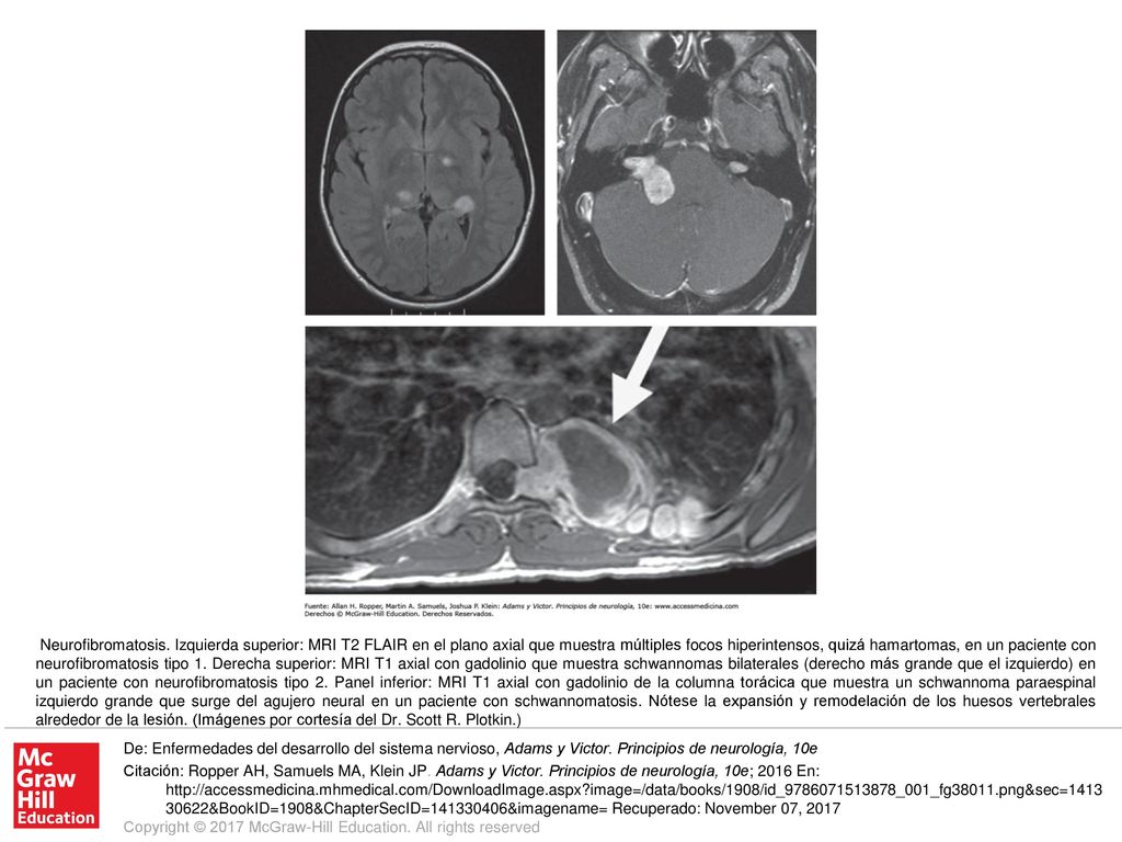 Neurofibromatosis. Izquierda superior: MRI T2 FLAIR en el plano axial que muestra múltiples focos hiperintensos, quizá hamartomas, en un paciente con neurofibromatosis tipo 1. Derecha superior: MRI T1 axial con gadolinio que muestra schwannomas bilaterales (derecho más grande que el izquierdo) en un paciente con neurofibromatosis tipo 2. Panel inferior: MRI T1 axial con gadolinio de la columna torácica que muestra un schwannoma paraespinal izquierdo grande que surge del agujero neural en un paciente con schwannomatosis. Nótese la expansión y remodelación de los huesos vertebrales alrededor de la lesión. (Imágenes por cortesía del Dr. Scott R. Plotkin.)