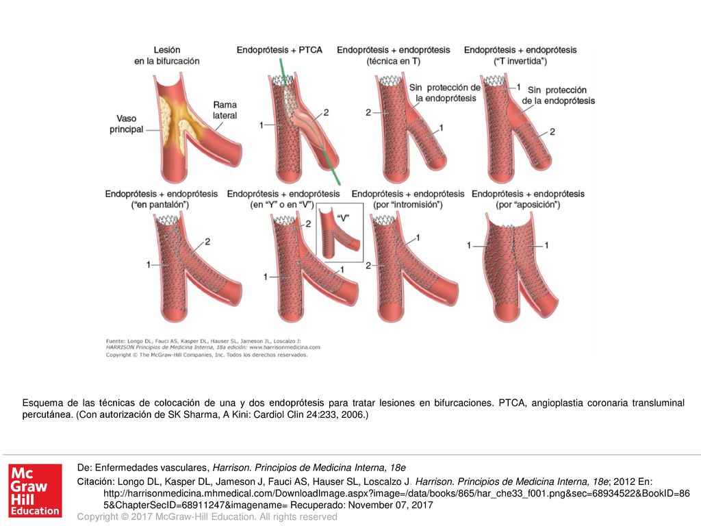 Esquema de las técnicas de colocación de una y dos endoprótesis para tratar lesiones en bifurcaciones. PTCA, angioplastia coronaria transluminal percutánea. (Con autorización de SK Sharma, A Kini: Cardiol Clin 24:233, 2006.)