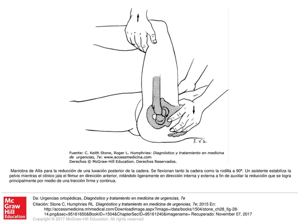 Maniobra de Allis para la reducción de una luxación posterior de la cadera. Se flexionan tanto la cadera como la rodilla a 90º. Un asistente estabiliza la pelvis mientras el clínico jala el fémur en dirección anterior, rotándolo ligeramente en dirección interna y externa a fin de auxiliar la reducción que se logra principalmente por medio de una tracción firme y continua.