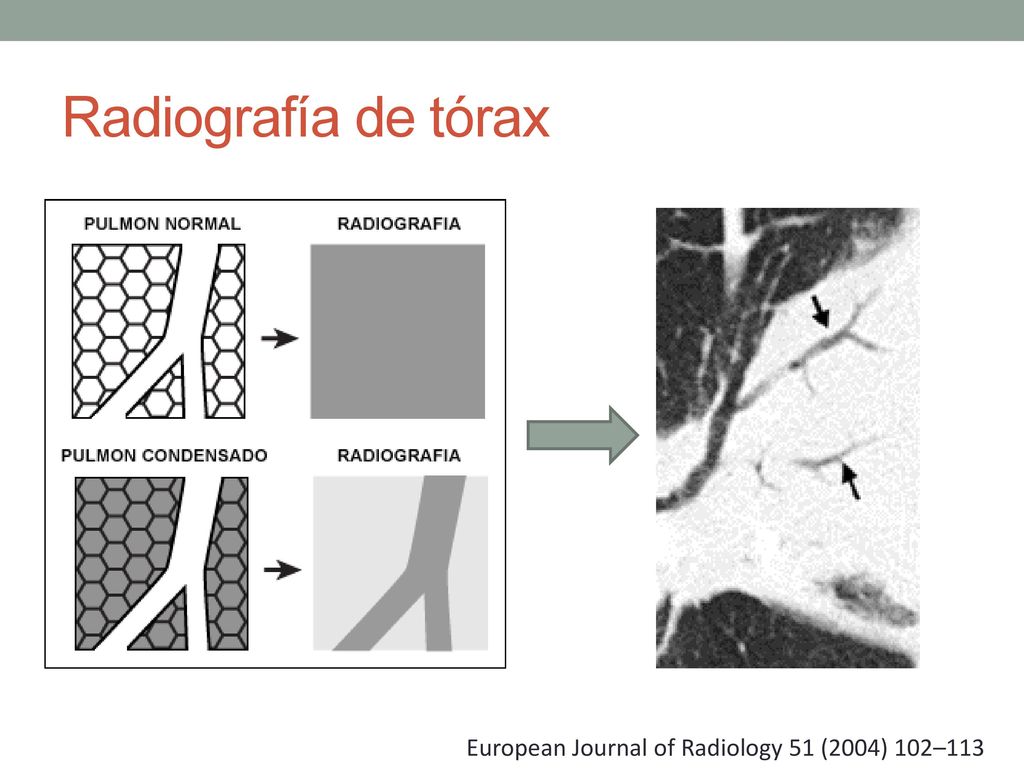 Radiografía de tórax European Journal of Radiology 51 (2004) 102–113