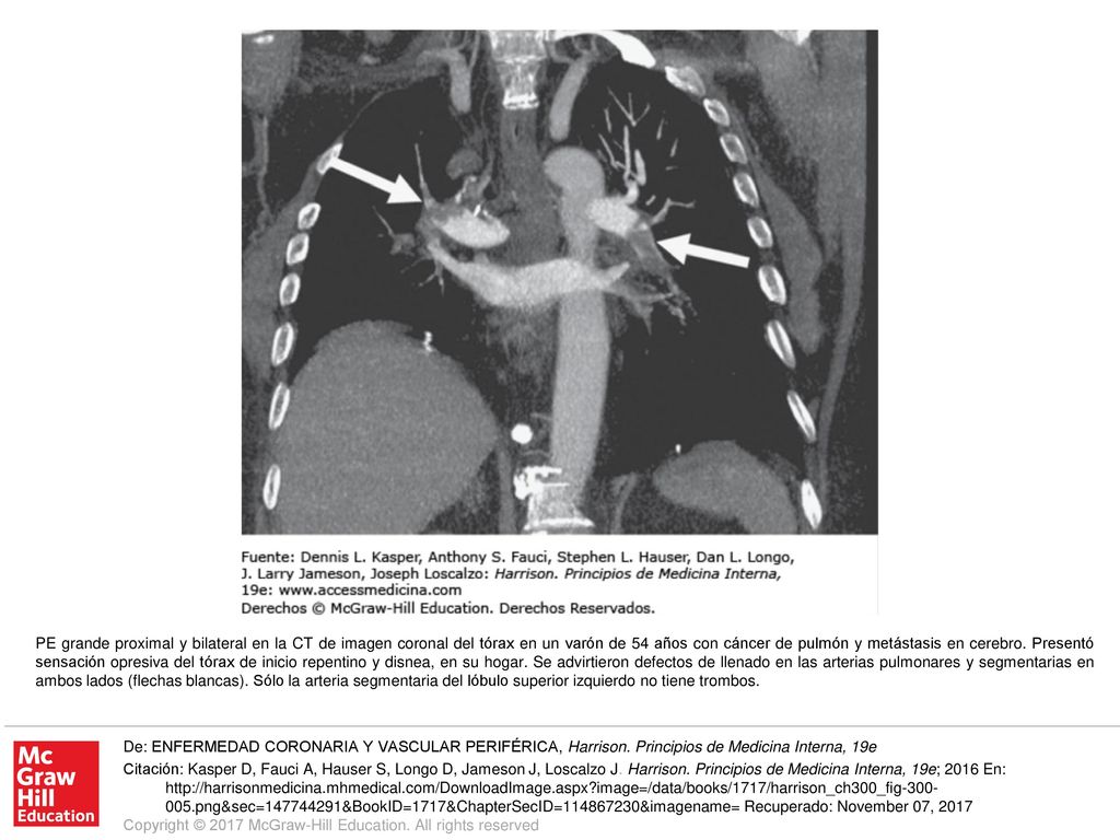 PE grande proximal y bilateral en la CT de imagen coronal del tórax en un varón de 54 años con cáncer de pulmón y metástasis en cerebro. Presentó sensación opresiva del tórax de inicio repentino y disnea, en su hogar. Se advirtieron defectos de llenado en las arterias pulmonares y segmentarias en ambos lados (flechas blancas). Sólo la arteria segmentaria del lóbulo superior izquierdo no tiene trombos.