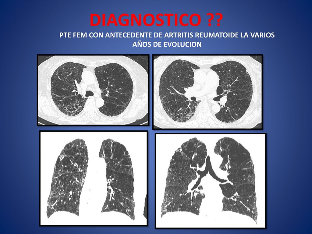 DIAGNOSTICO PTE FEM CON ANTECEDENTE DE ARTRITIS REUMATOIDE LA VARIOS AÑOS DE EVOLUCION