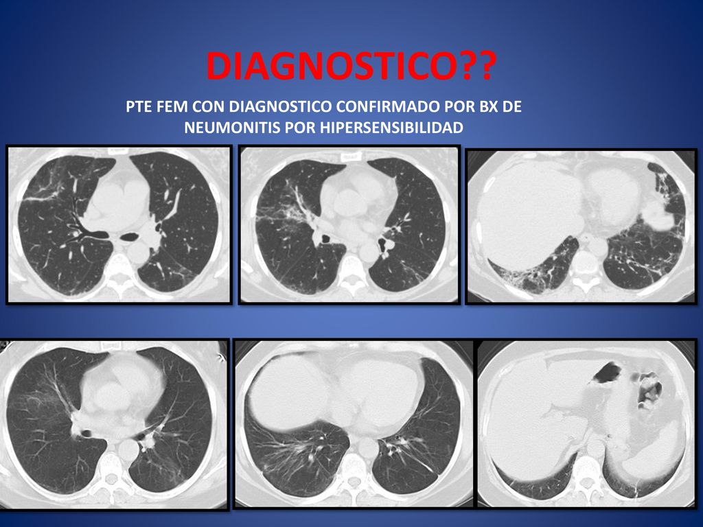 DIAGNOSTICO PTE FEM CON DIAGNOSTICO CONFIRMADO POR BX DE NEUMONITIS POR HIPERSENSIBILIDAD
