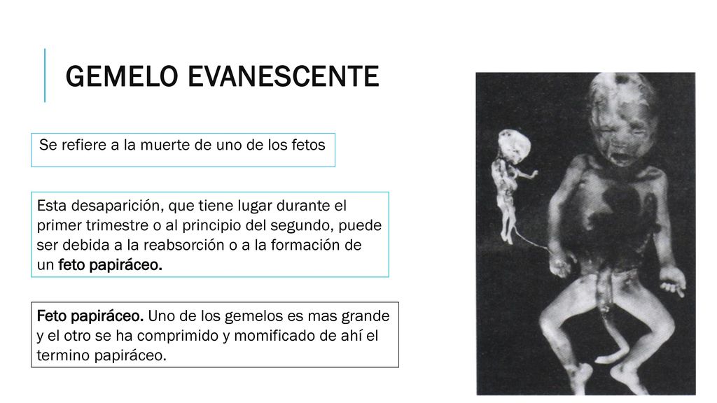 Gemelo evanescente Se refiere a la muerte de uno de los fetos