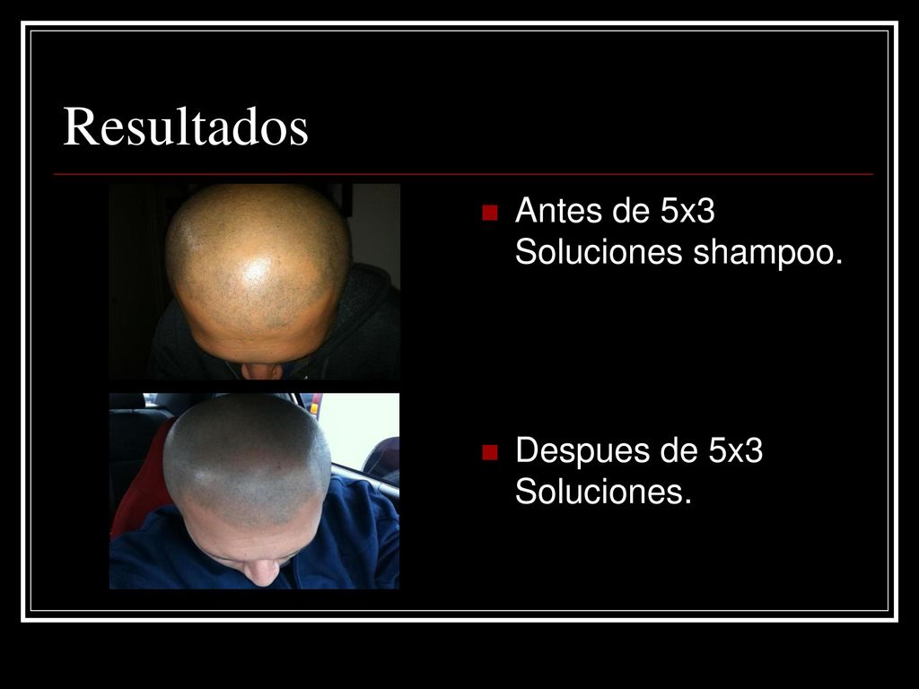 Resultados Antes de 5x3 Soluciones shampoo. Despues de 5x3 Soluciones.