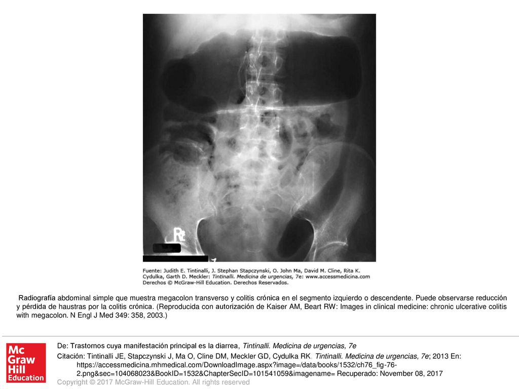 Radiografía abdominal simple que muestra megacolon transverso y colitis crónica en el segmento izquierdo o descendente. Puede observarse reducción y pérdida de haustras por la colitis crónica. (Reproducida con autorización de Kaiser AM, Beart RW: Images in clinical medicine: chronic ulcerative colitis with megacolon. N Engl J Med 349: 358, 2003.)