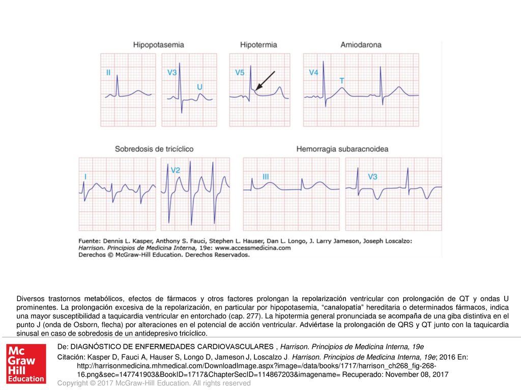 Diversos trastornos metabólicos, efectos de fármacos y otros factores prolongan la repolarización ventricular con prolongación de QT y ondas U prominentes. La prolongación excesiva de la repolarización, en particular por hipopotasemia, canalopatía hereditaria o determinados fármacos, indica una mayor susceptibilidad a taquicardia ventricular en entorchado (cap. 277). La hipotermia general pronunciada se acompaña de una giba distintiva en el punto J (onda de Osborn, flecha) por alteraciones en el potencial de acción ventricular. Adviértase la prolongación de QRS y QT junto con la taquicardia sinusal en caso de sobredosis de un antidepresivo tricíclico.