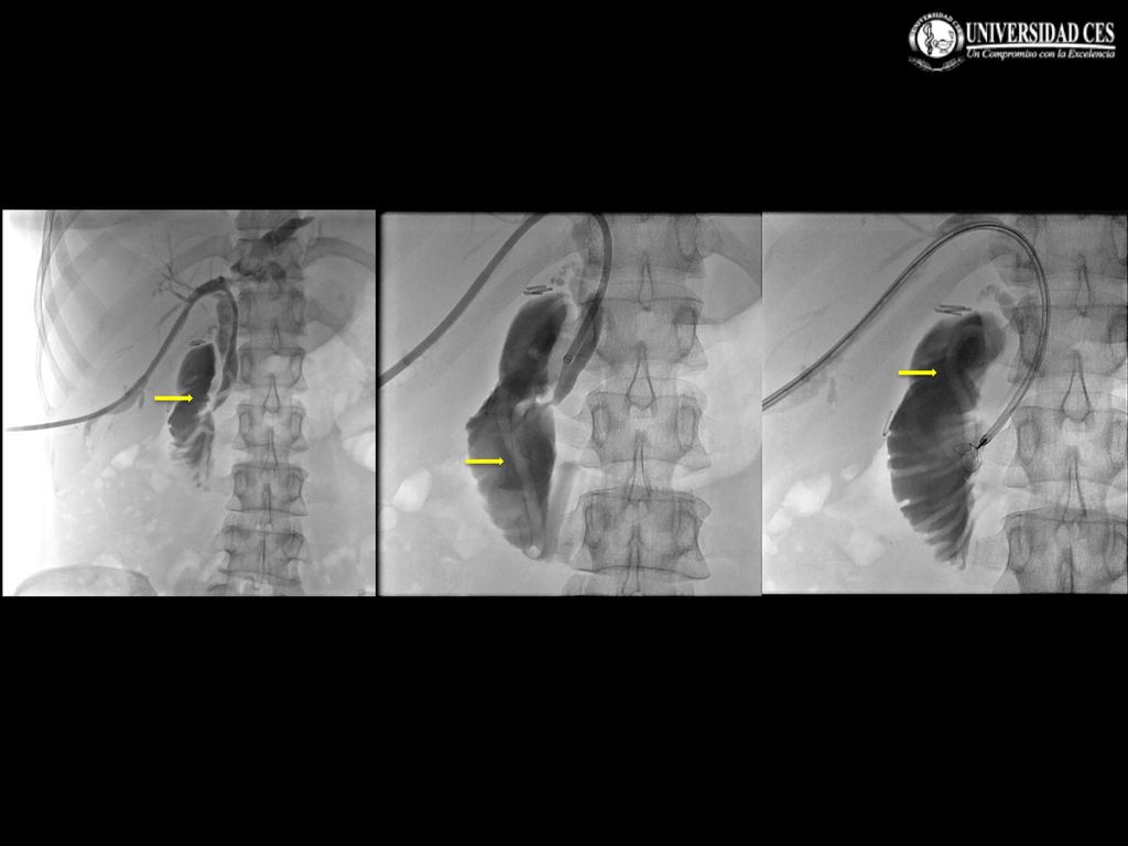 A continuación se pasa introductor vascular 8fr y a través de él, un lazo recuperador y se logra extraer el áscaris al intestino. Como lo indican las flechas.