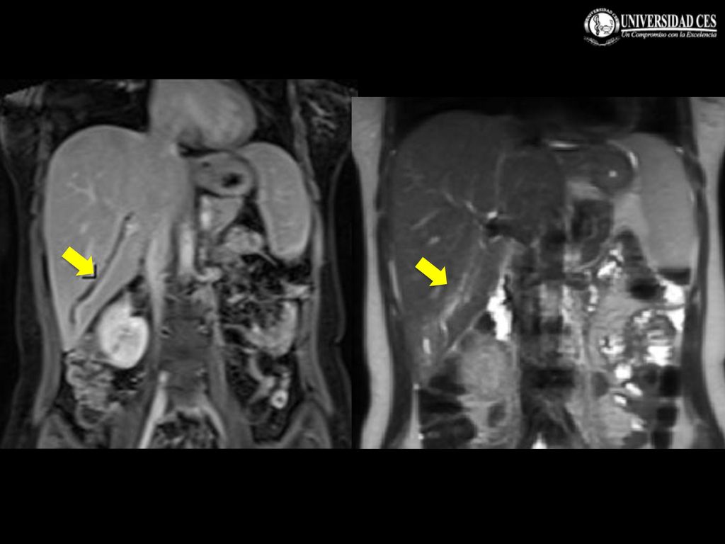 Finalmente en la secuencia T1 coronal contrastada se identifica imagen tubular en el conducto hepático derecho que corresponde al áscaris asociado a hiperintensidad periférica del parénquima hepático que se observa en el T2 por cambios inflamatorios asociados. Como lo indican las flechas.
